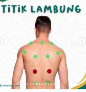 Titik bekam asam lambung