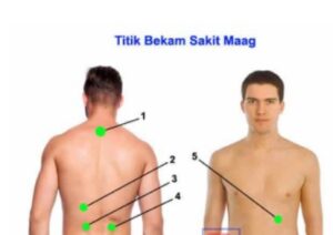 Titik bekam asam lambung